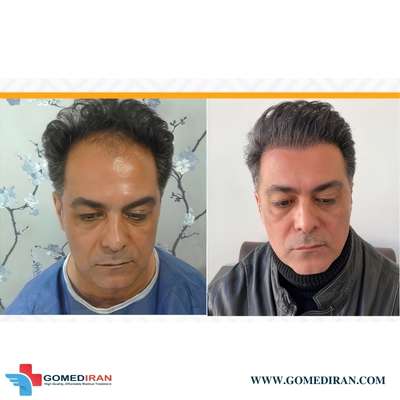 Hair Transplant in Iran | Best hair centers | GOMEDIRAN