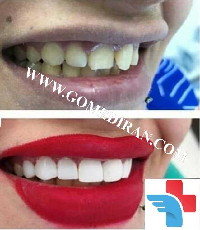 Hollywood smile before and after in Iran