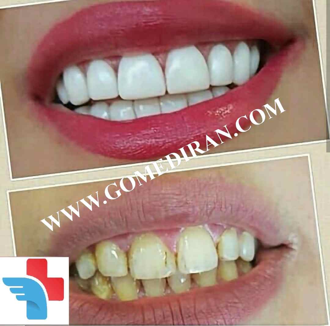 Hollywood smile before and after in Iran
