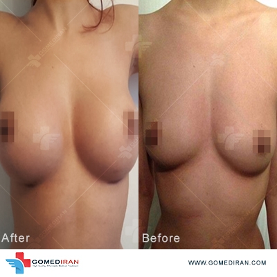 breast implant before and after n iran
