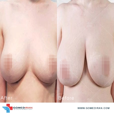 breast reduction before and after in iran