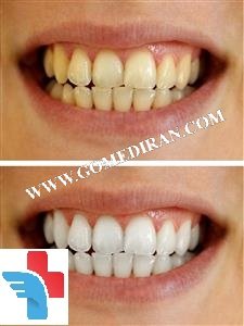 Teeth whitening before and after in Iran