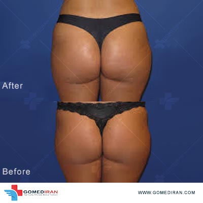 brazilian butt lift before and after in Iran