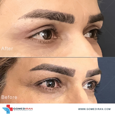 blepharoplasty before and after in iran