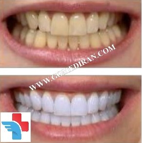 Teeth whitening before and after in Iran