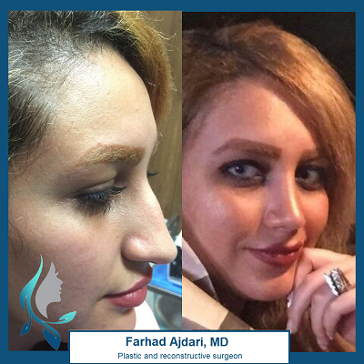 Dr. Farhad Ajdari Before and afters