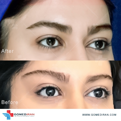 blepharoplasty before and after in iran