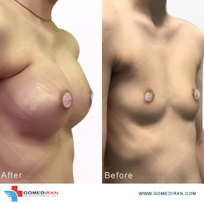 breast implant before and after n iran