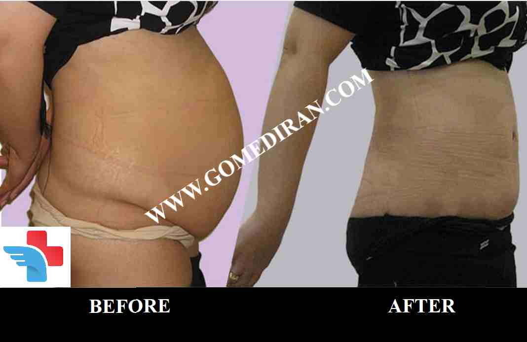 Tummy tuck surgery before and after in Iran