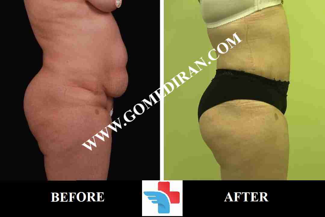 Tummy tuck surgery before and after in Iran