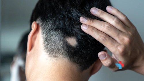 Alopecia Areata