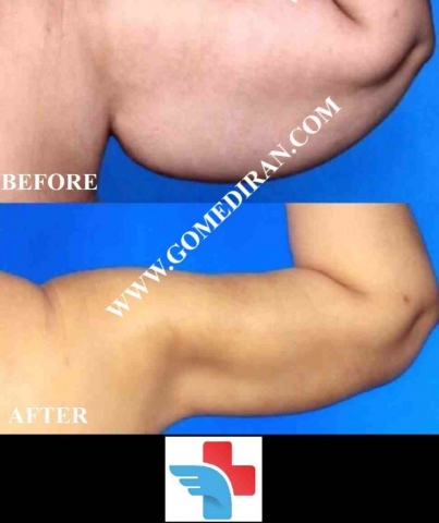 Arm lift surgery before and after in Iran