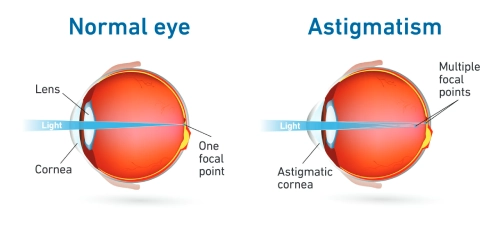 Benefits of Laser Eye Surgery for Astigmatism