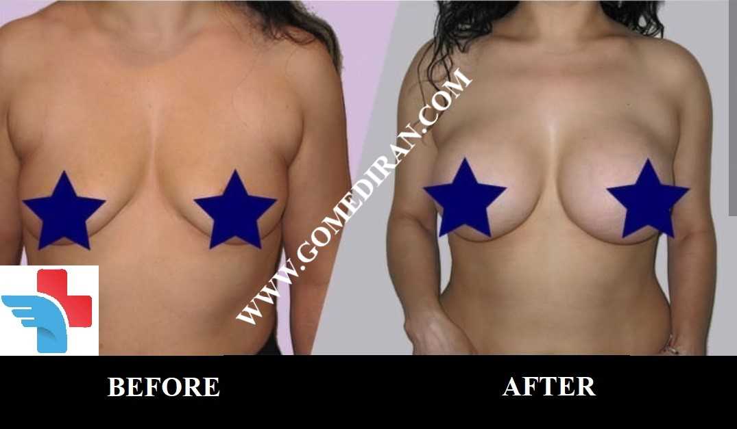 Breast augmentation surgery before and after in Iran