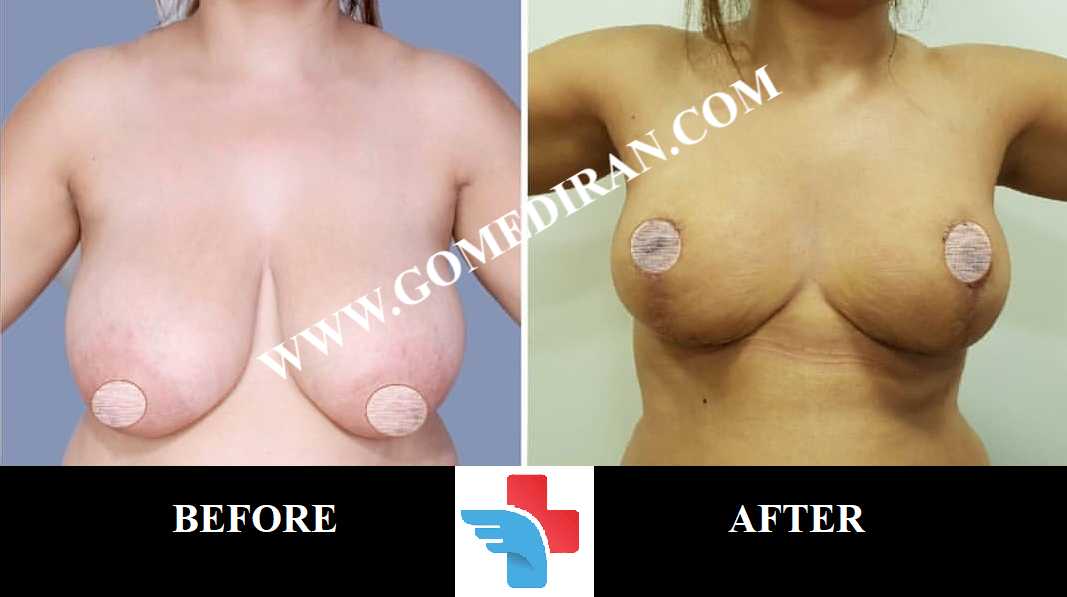 Breast lift Surgery before and after in Iran