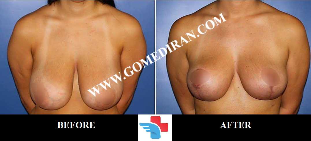 Breast lift Surgery before and after in Iran