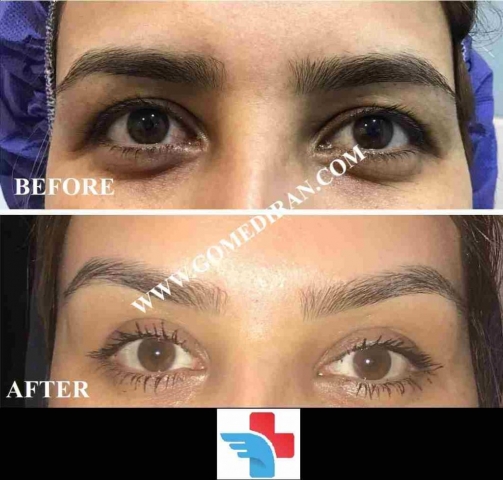 Browlift surgery before and after in Iran