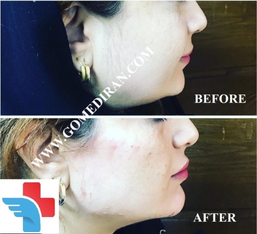 Chin augmentation surgery before and after in Iran
