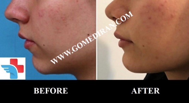 Chin augmentation surgery before and after in Iran
