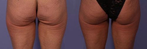 Cryolipolysis butt