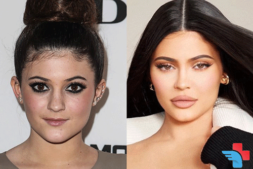Did Kylie Jenner Get Plastic Surgery?
