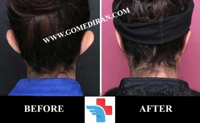 Ear reshaping surgery before and after in Iran