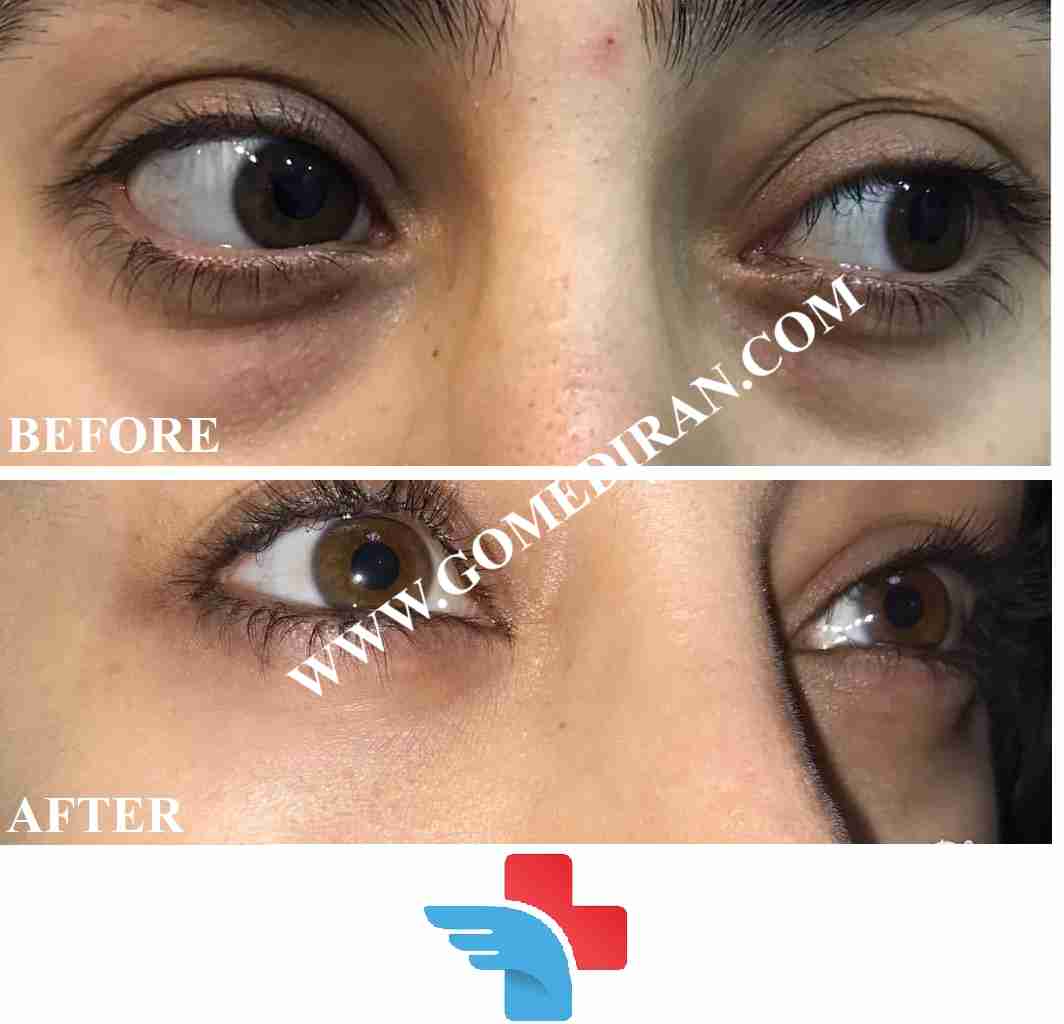 Eyelid Surgery before and after in Iran
