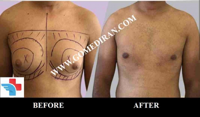 Gynecomastia surgery before and after in iran