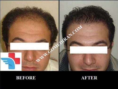 Hair transplant before and after in Iran