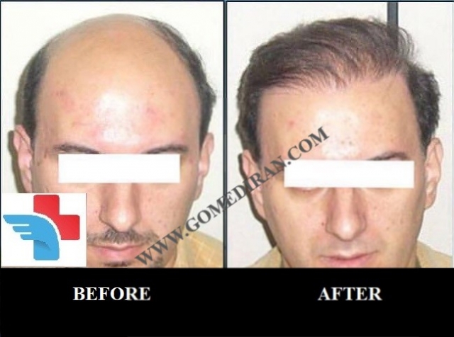 Hair transplant before and after in Iran