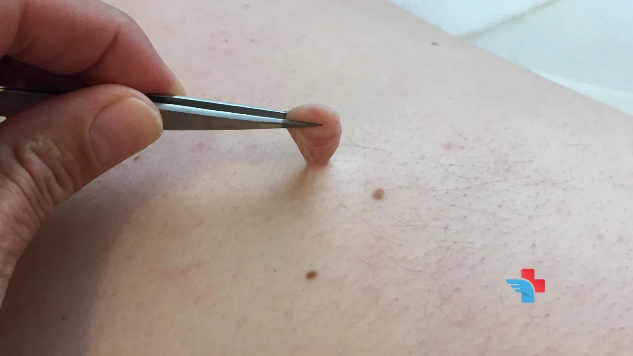 How to Get Rid of Skin Tags؟