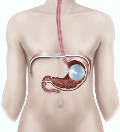 How-to-place-the-balloon-inside-the-stomach-