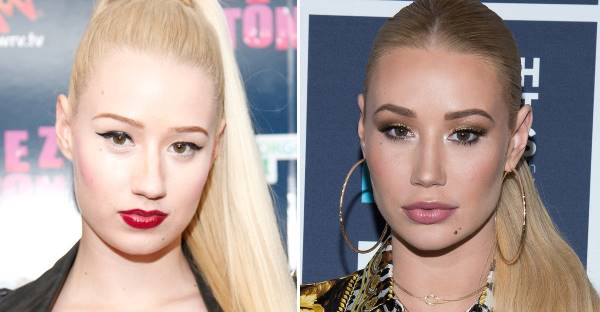 Iggy Azalea plastic surgery