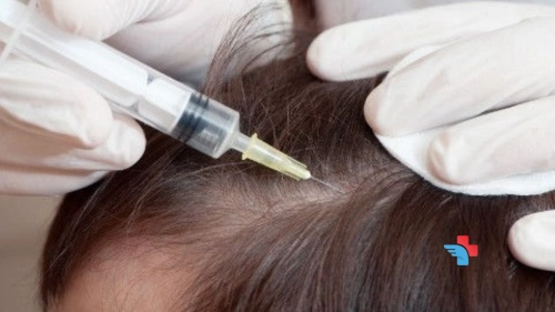 Injections for alopecia areata