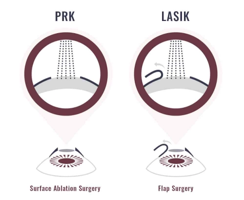 Laser Eye Surgery Techniques for Astigmatism