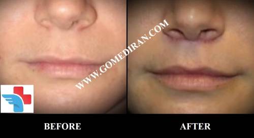 Lip lift Surgery before and after in Iran