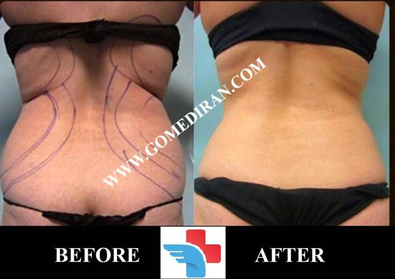 liposuction Surgery before and after in Iran