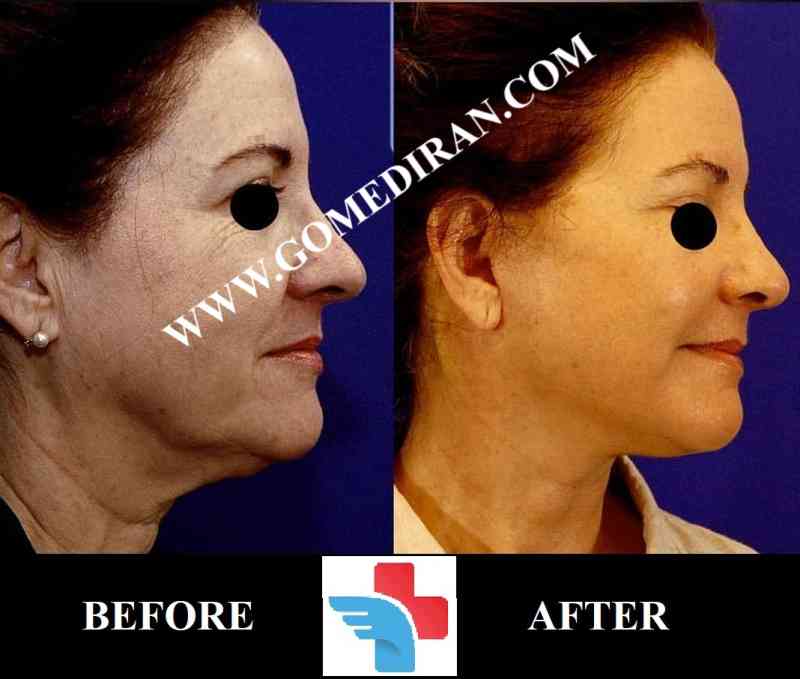 Facelift surgery before and after in Iran