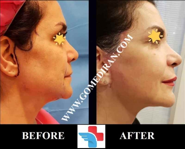 Necklift surgery before and after in Iran