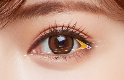 Recovering from canthoplasty
