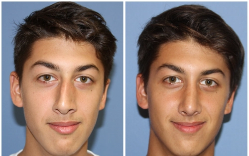 Rhinoplasty for Functional Improvement