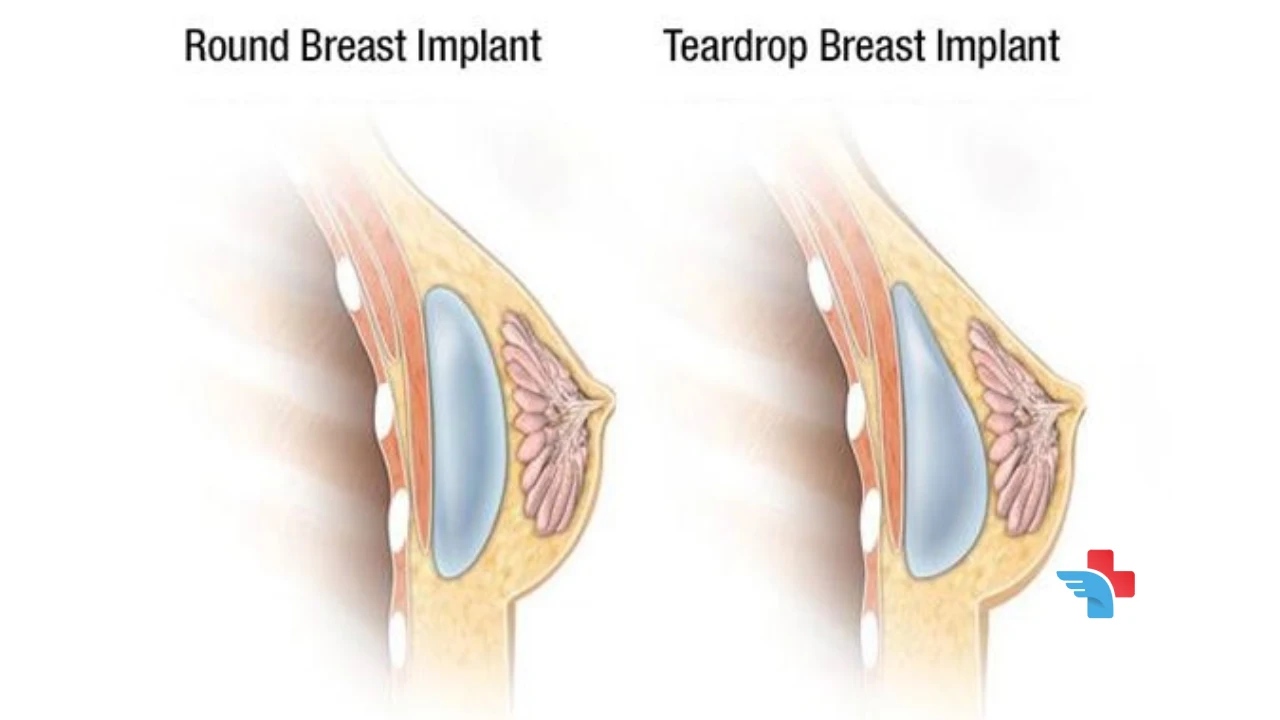 Round Implants vs. Teardrop Implants