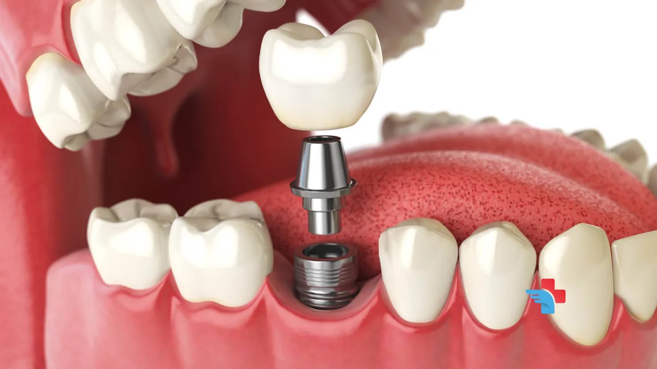 Same-Day Dental Implants