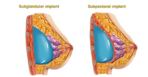 Subglandular vs. Submuscular Placement