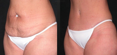 The Benefits of Tummy Tuck Beyond Stretch Marks