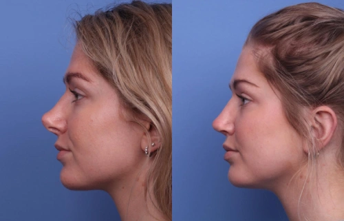 What to Think About Before Getting Multiple Nose Jobs?