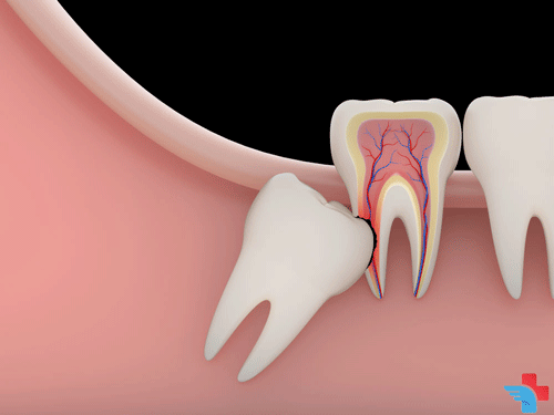 Wisdom Tooth and All That We Should Know About It