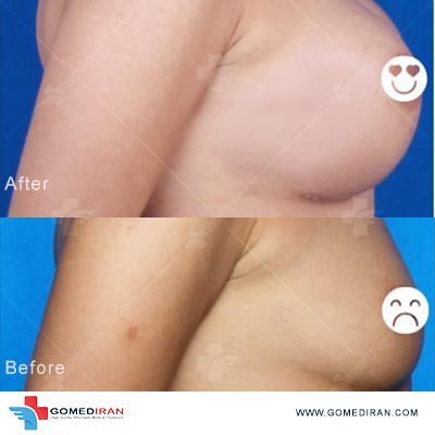 breast implant before and after in Iran