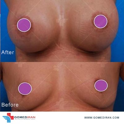 breast implant before and after in Iran