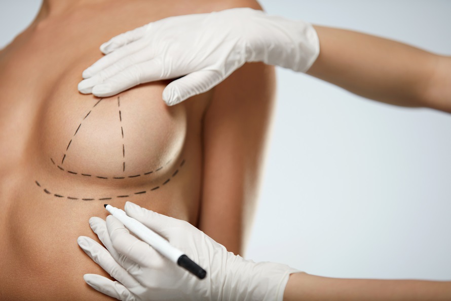 breast-lift